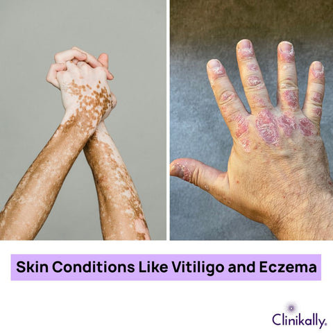 Skin Conditions Like Vitiligo and Eczema