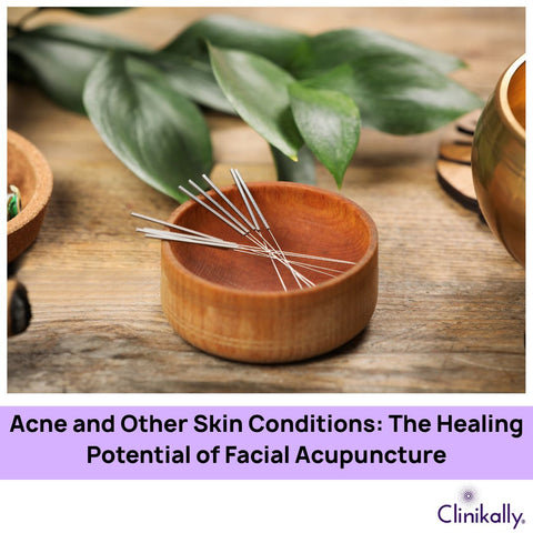 Acne and Other Skin Conditions: The Healing Potential of Facial Acupuncture