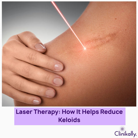 Laser therapy for keloid reduction