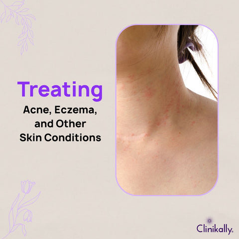 Treating Acne, Eczema, and Other Skin Conditions