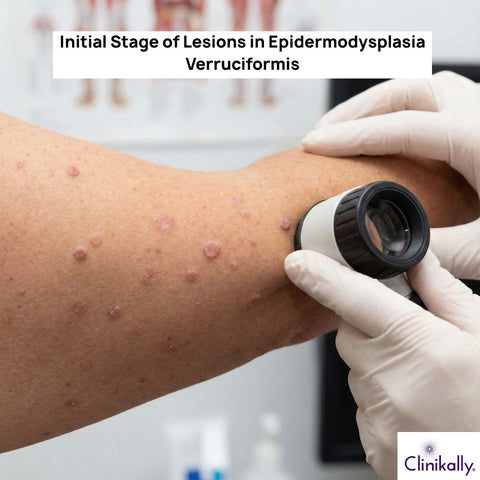 Initial Stage of Lesions in Epidermodysplasia Verruciformis