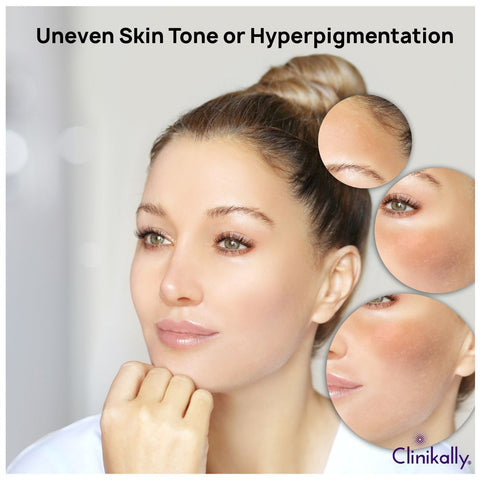 Uneven Skin Tone or Hyperpigmentation