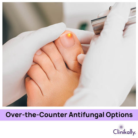 Over-the-Counter Antifungal Options