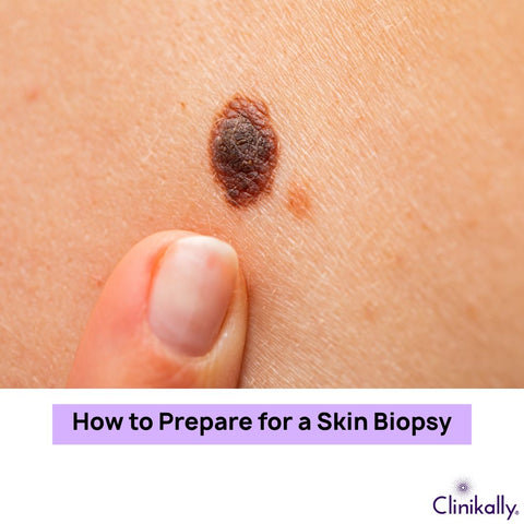 How to Prepare for a Skin Biopsy