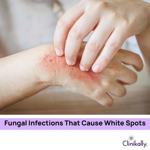 Fungal Infections That Cause White Spots