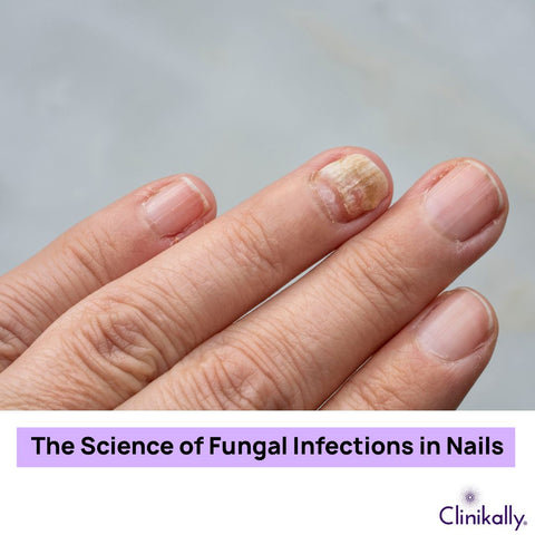 The Science of Fungal Infections in Nails