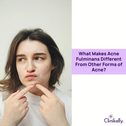 What Makes Acne Fulminans Different From Other Forms of Acne?