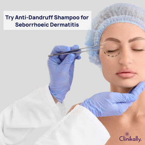 Try Anti-Dandruff Shampoo for Seborrhoeic Dermatitis
