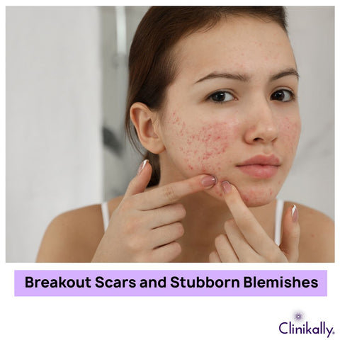 Breakout Scars and Stubborn Blemishes