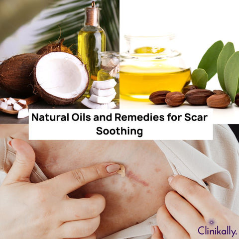 Natural Oils and Remedies for Scar Soothing