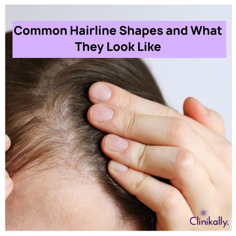 Common Hairline Shapes and What They Look Like