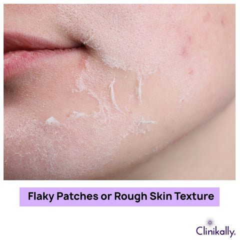 Flaky Patches or Rough Skin Texture