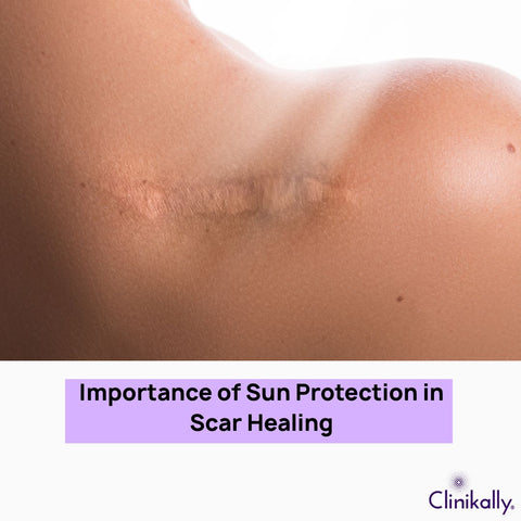 Importance of Sun Protection in Scar Healing