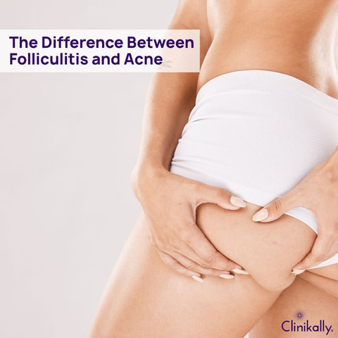 The Difference Between Folliculitis and Acne