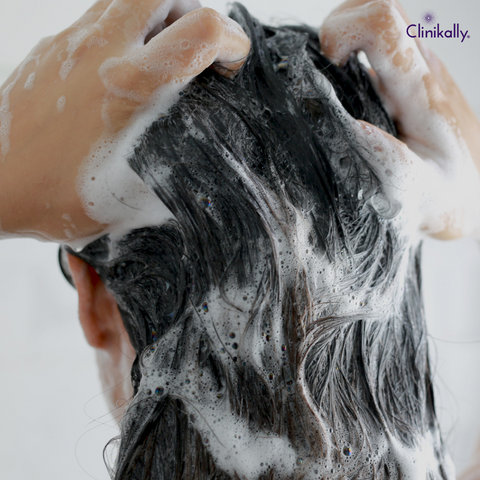 dandruff vs dry scalp