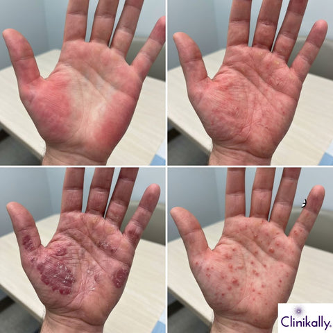 Stages of palmar erythema with palm redness and rash