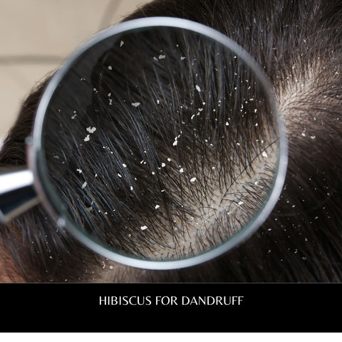 Hibiscus for Dandruff