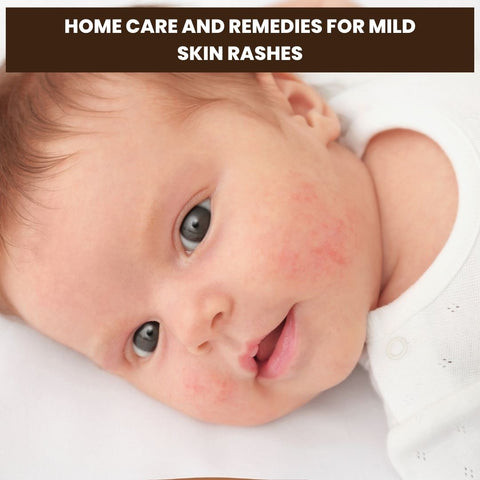 Home Care and Remedies for Mild Skin Rashes