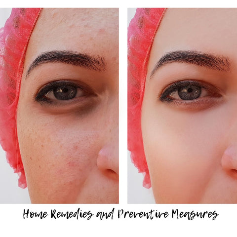 Home Remedies and Preventive Measures