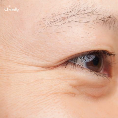 Retin-A for Wrinkles and Aging Skin: How to Use it Safely and Effectively
