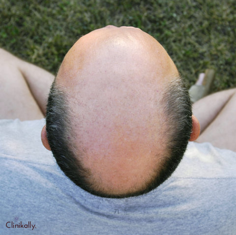 androgenetic alopecia 