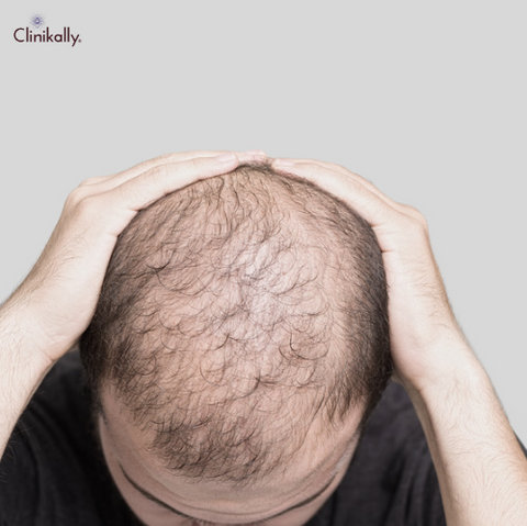 Minoxidil Vs Finasteride