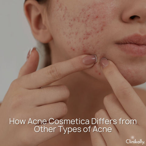 How Acne Cosmetica Differs from Other Types of Acne