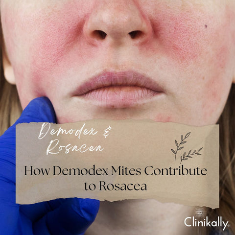 How Demodex Mites Contribute to Rosacea