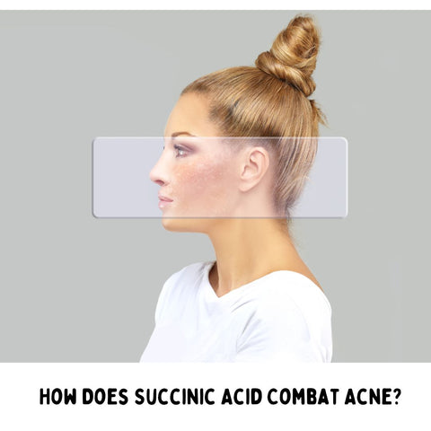 How Does Succinic Acid Combat Acne?