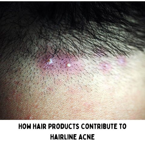 How Hair Products Contribute to Hairline Acne