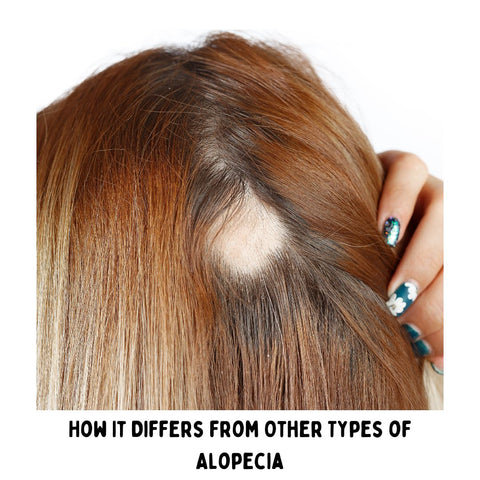 How It Differs from Other Types of Alopecia