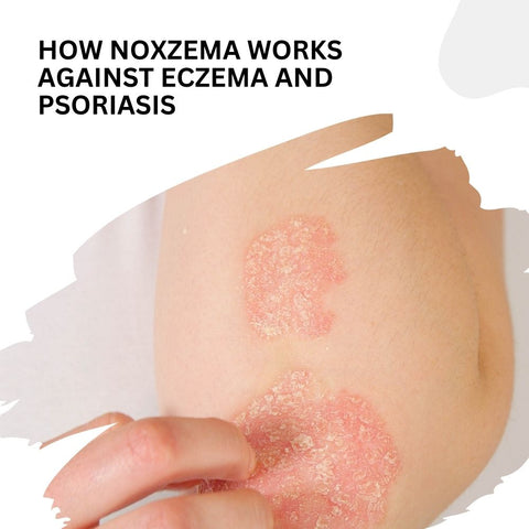 How Noxzema Works Against Eczema and Psoriasis