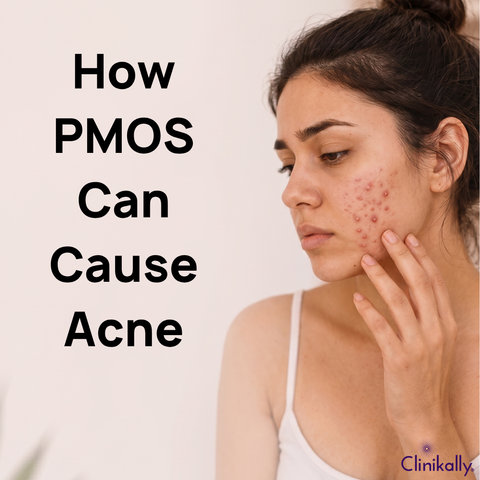 PMOS hormonal acne and inflamed facial breakouts