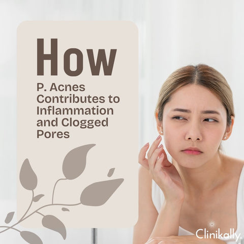 How P. Acnes Contributes to Inflammation and Clogged Pores