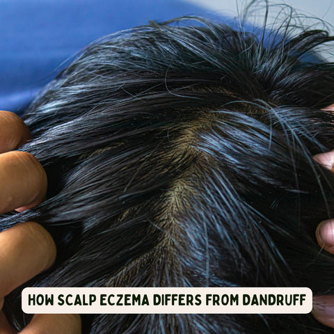 How Scalp Eczema Differs from Dandruff