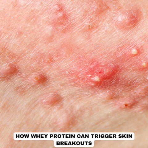 How Whey Protein Can Trigger Skin Breakouts