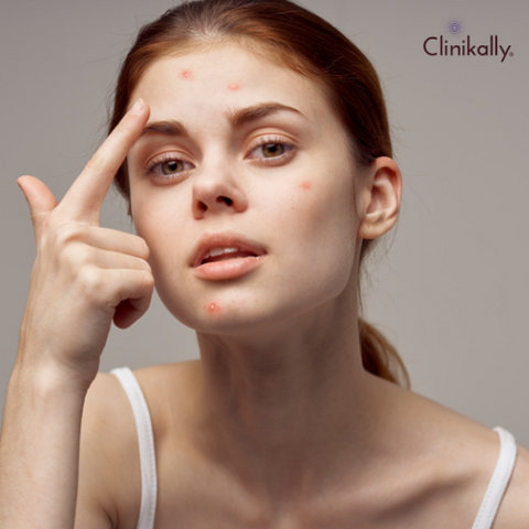 Is acne genetically inherited?