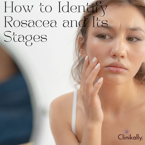 How to Identify Rosacea and Its Stages