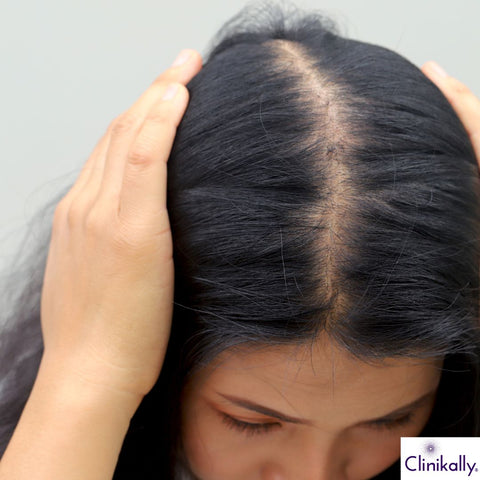 Woman showing hair thinning at scalp parting