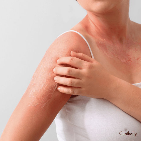 What is broken or compromised skin?