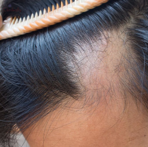 Topical Minoxidil for Hair Loss: Benefits, Side Effects, & How to Use