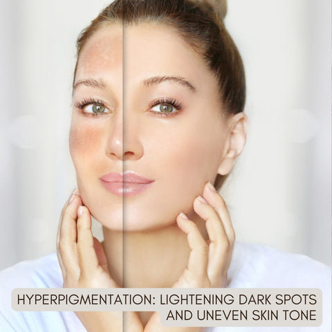 Hyperpigmentation: Lightening Dark Spots and Uneven Skin Tone
