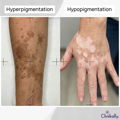 Hyperpigmentation vs Hypopigmentation