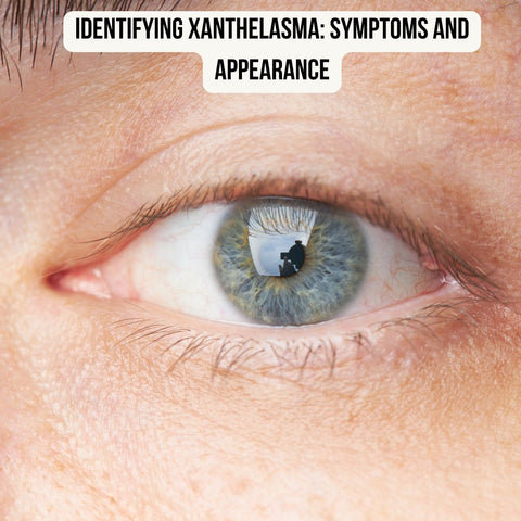 Identifying Xanthelasma: Symptoms and Appearance