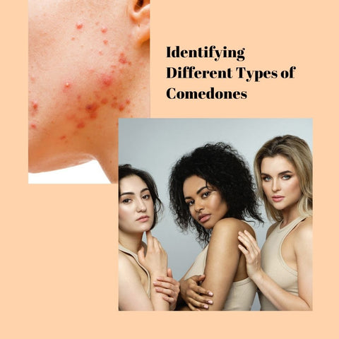 Identifying Different Types of Comedones