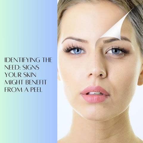 Identifying the Need: Signs Your Skin Might Benefit from a Peel
