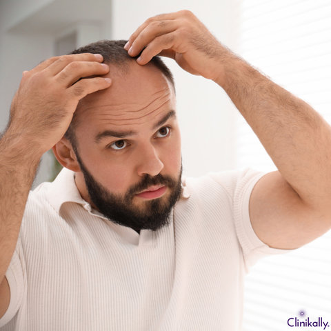 Man inspecting a receding hairline in a mirror.