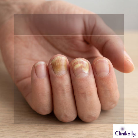 Yellow and damaged fungal fingernails