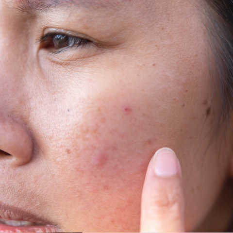 Rosacea