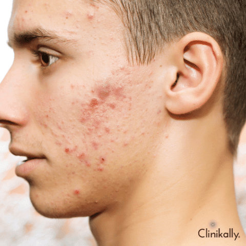 Acne Vulgaris: Causes, Treatment & Home Remedies 